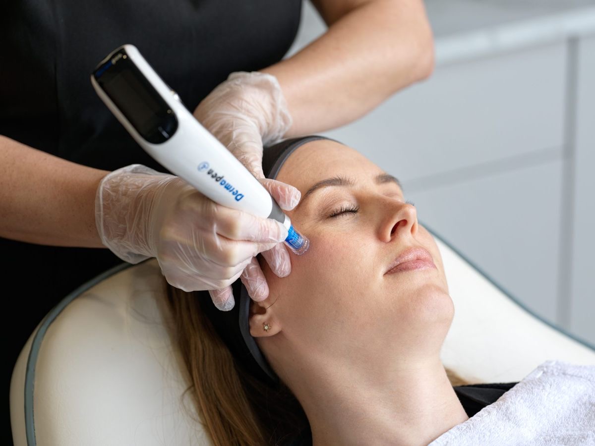 microneedling-img